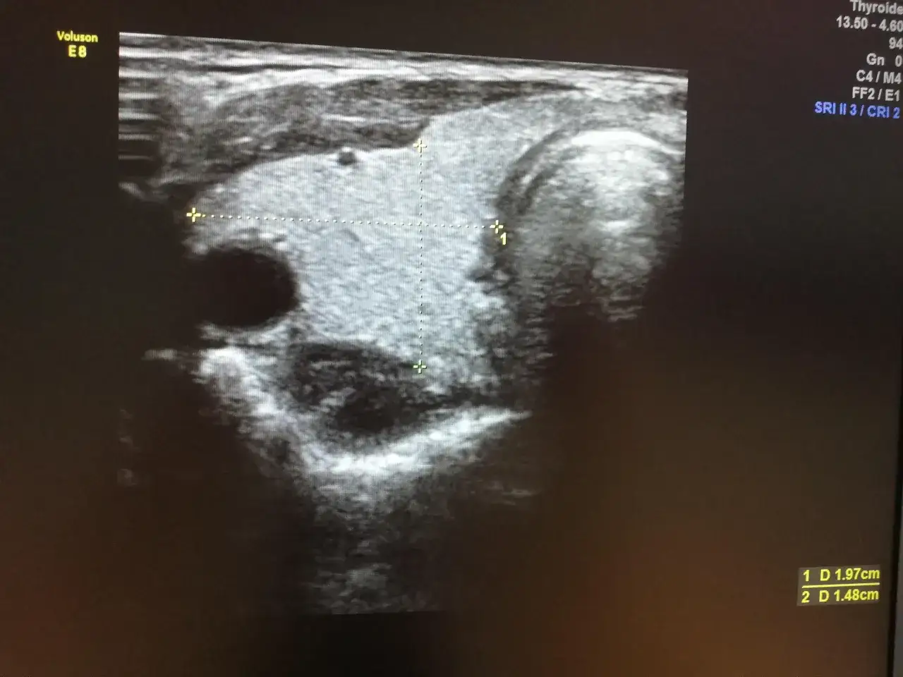 USG tarczycy z zaznaczonymi wymiarami: 1.97 cm i 1.48 cm. Wyniki te pomagają ocenić wymiary tarczycy usg norma.