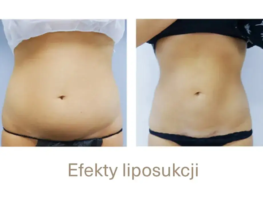 Kobieta przed i po liposukcji brzucha
