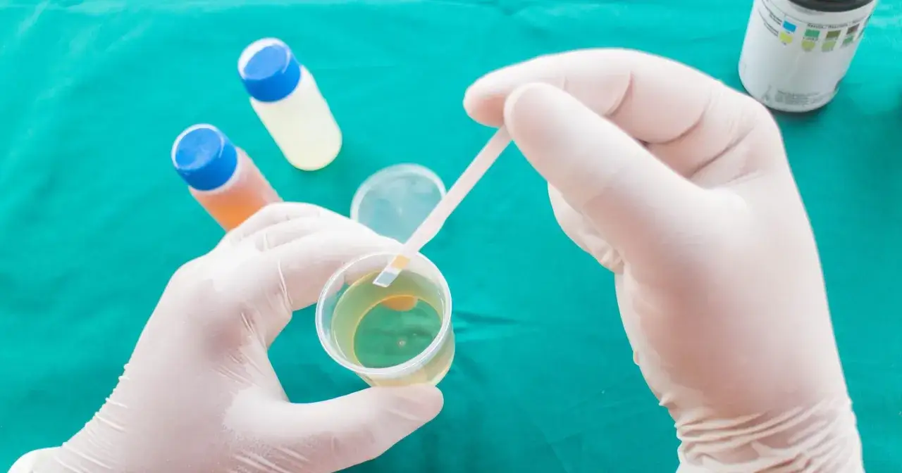 Rękawiczki medyczne zanurzają pasek testowy w pr&oacute;bce moczu, wskazując na obecność leukocyt&oacute;w w moczu 30-50.