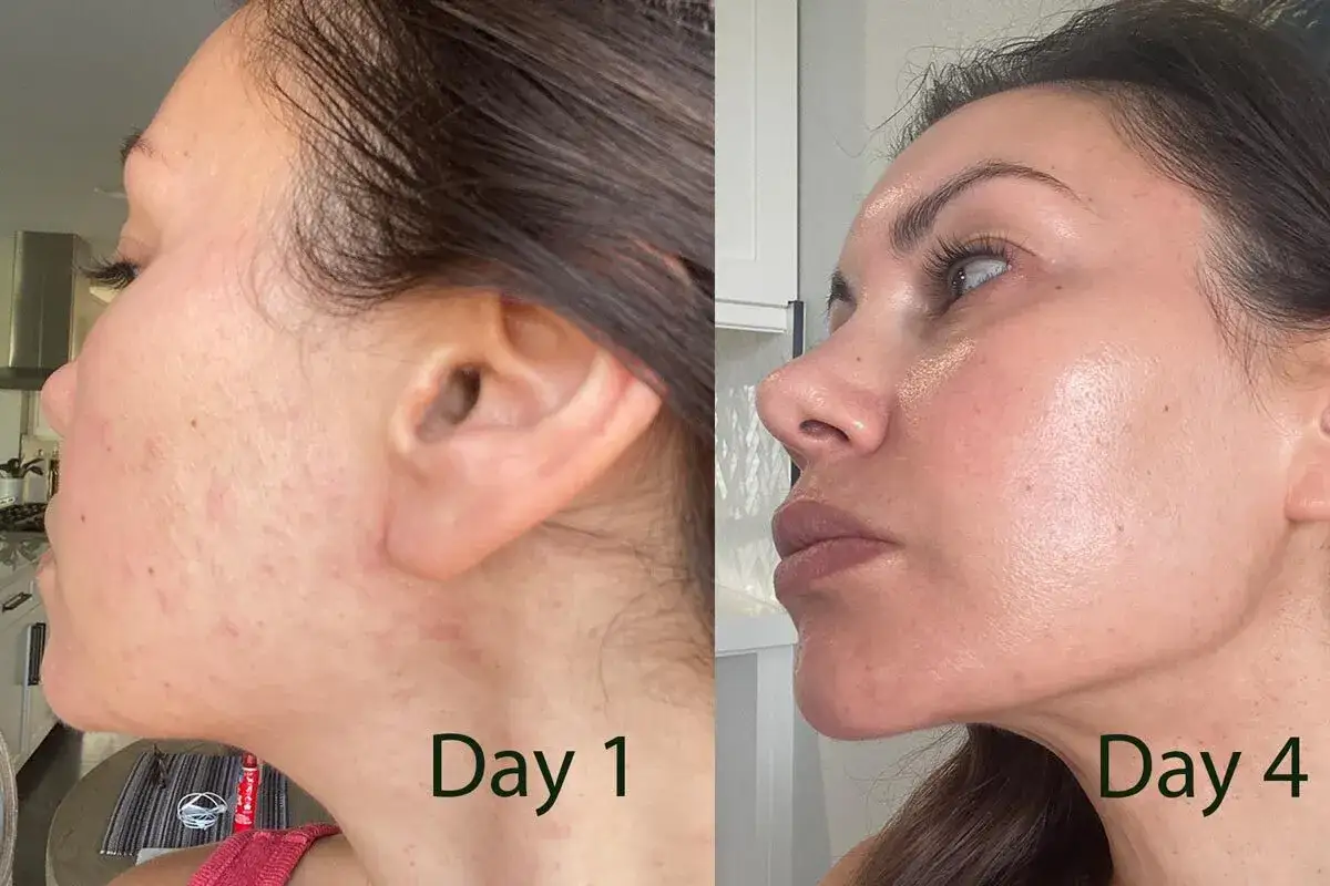 Przed i po: skóra z trądzikiem grzybiczym na twarzy, widoczna poprawa po 3 dniach.