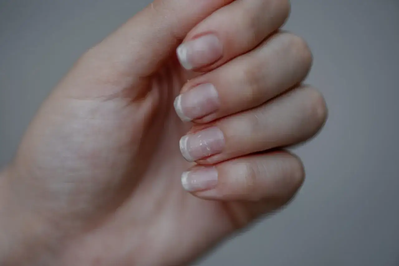 Dłoń z widocznymi białymi plamkami na paznokciach, które mogą świadczyć o niedoborach lub uszkodzeniach.