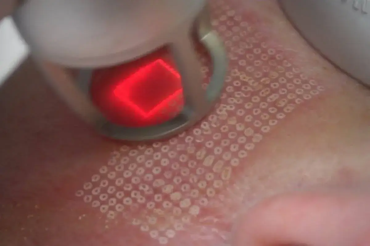 Laser frakcyjny zastosowania problemy sk&oacute;rne