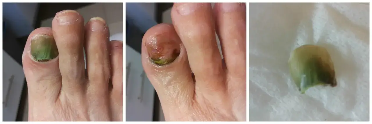 Zielona bakteria na paznokciu, widoczna na zdjęciach, może być leczona domowymi sposobami.