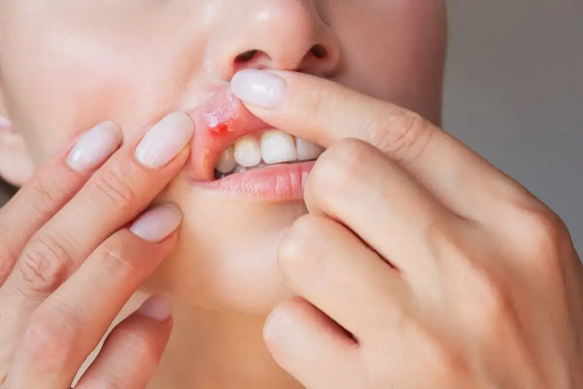 Dłoń odsłaniająca bolącą aftę na wardze. Czy afta sama zniknie?