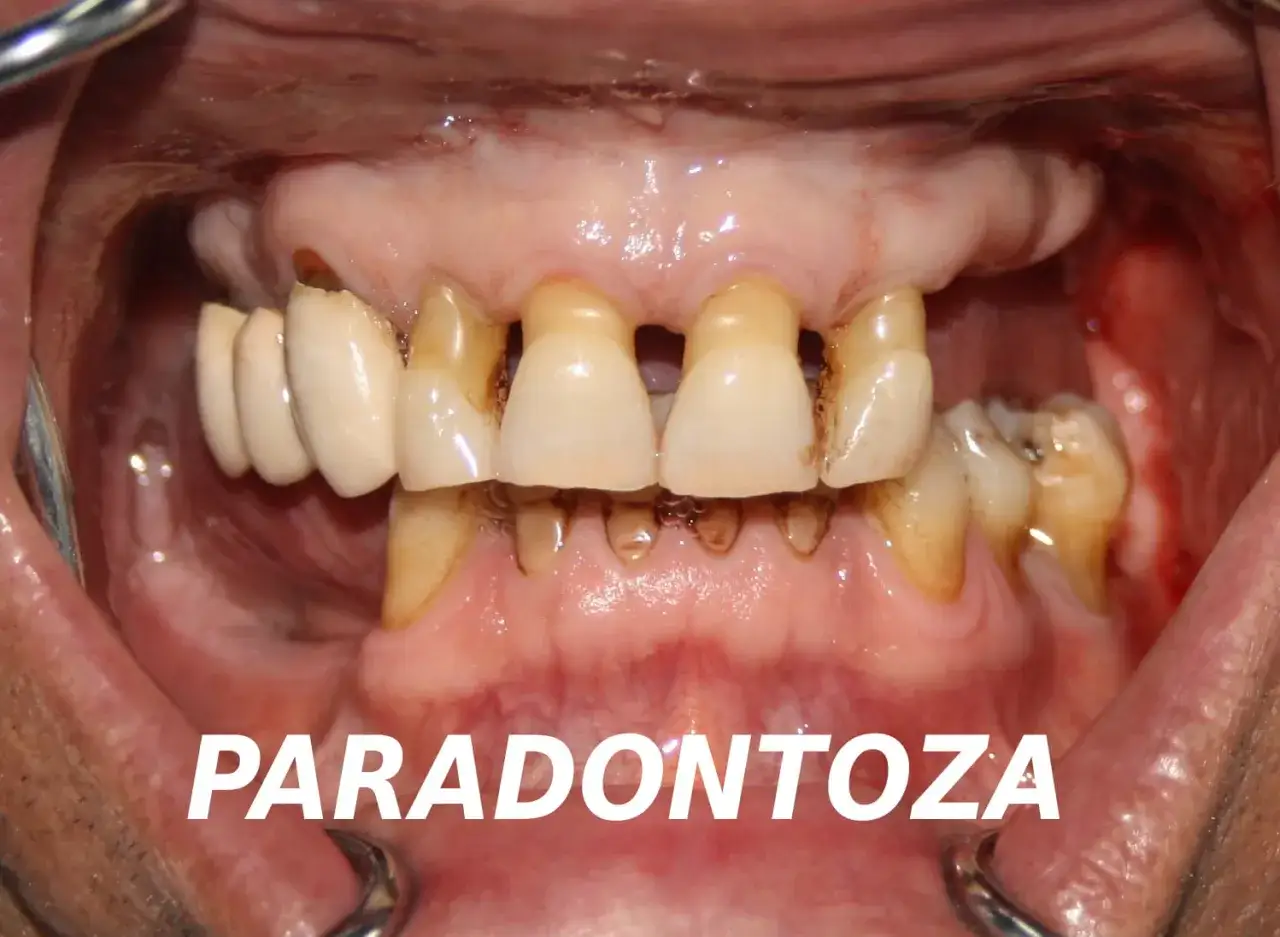 Zaawansowana paradontoza kiedy wypadają zęby. Widoczne ubytki, zanik dziąseł i próchnica.