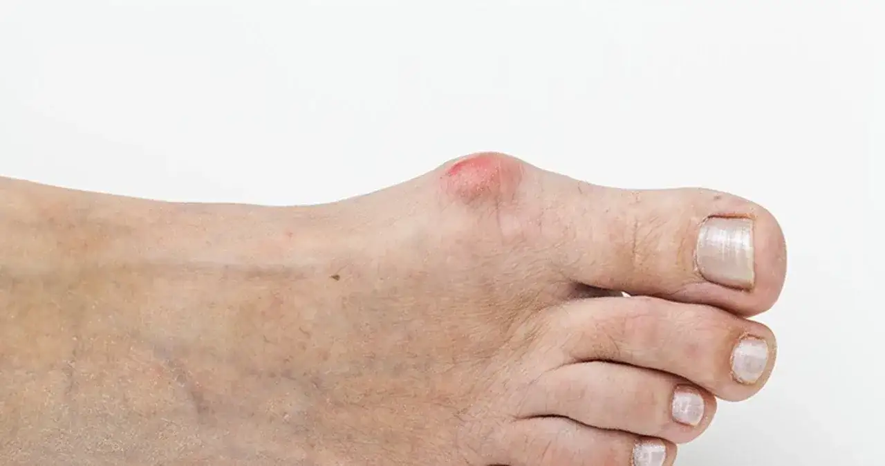 Zdjęcie Czy jodyna pomaga na haluksy? Sprawdź skuteczność i bezpieczeństwo