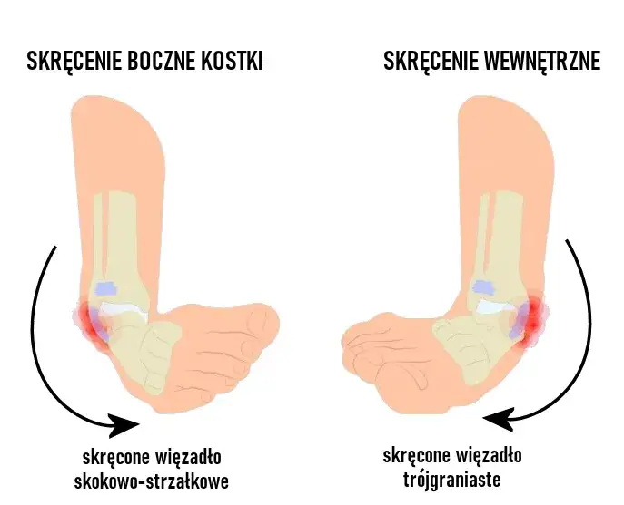 różnica zwichnięcie skręcenie stawu schemat
