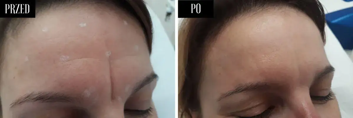 Botoks lwia zmarszczka przed po