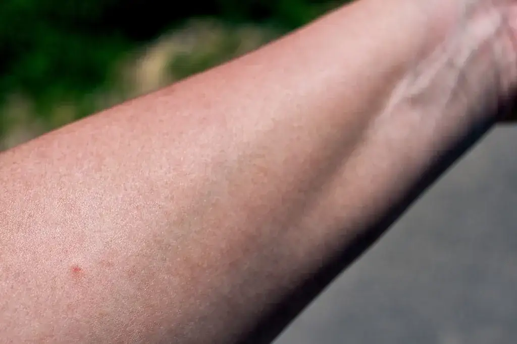 Zdjęcie Jak wygląda miejsce po kleszczu? Objawy, zmiany skórne i ryzyko boreliozy