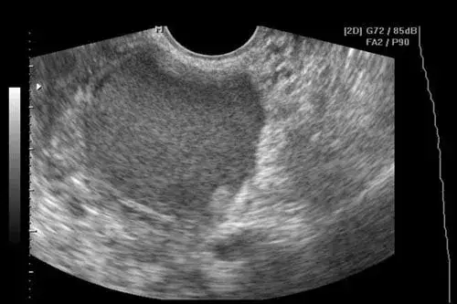 torbiel jajnika, endometrioza objawy