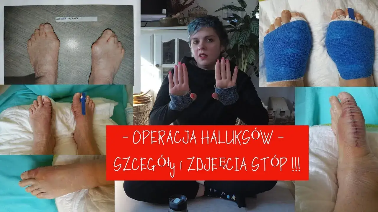 Operacja haluksów NFZ czy prywatnie porównanie