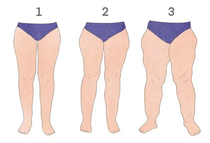 Rodzaje cellulitu, obrzęki nóg