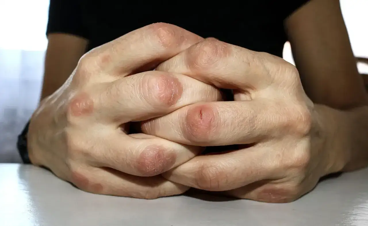 Skóra na dłoniach jest zaczerwieniona i łuszcząca się, co może wskazywać na uczulenie na pastę do zębów.