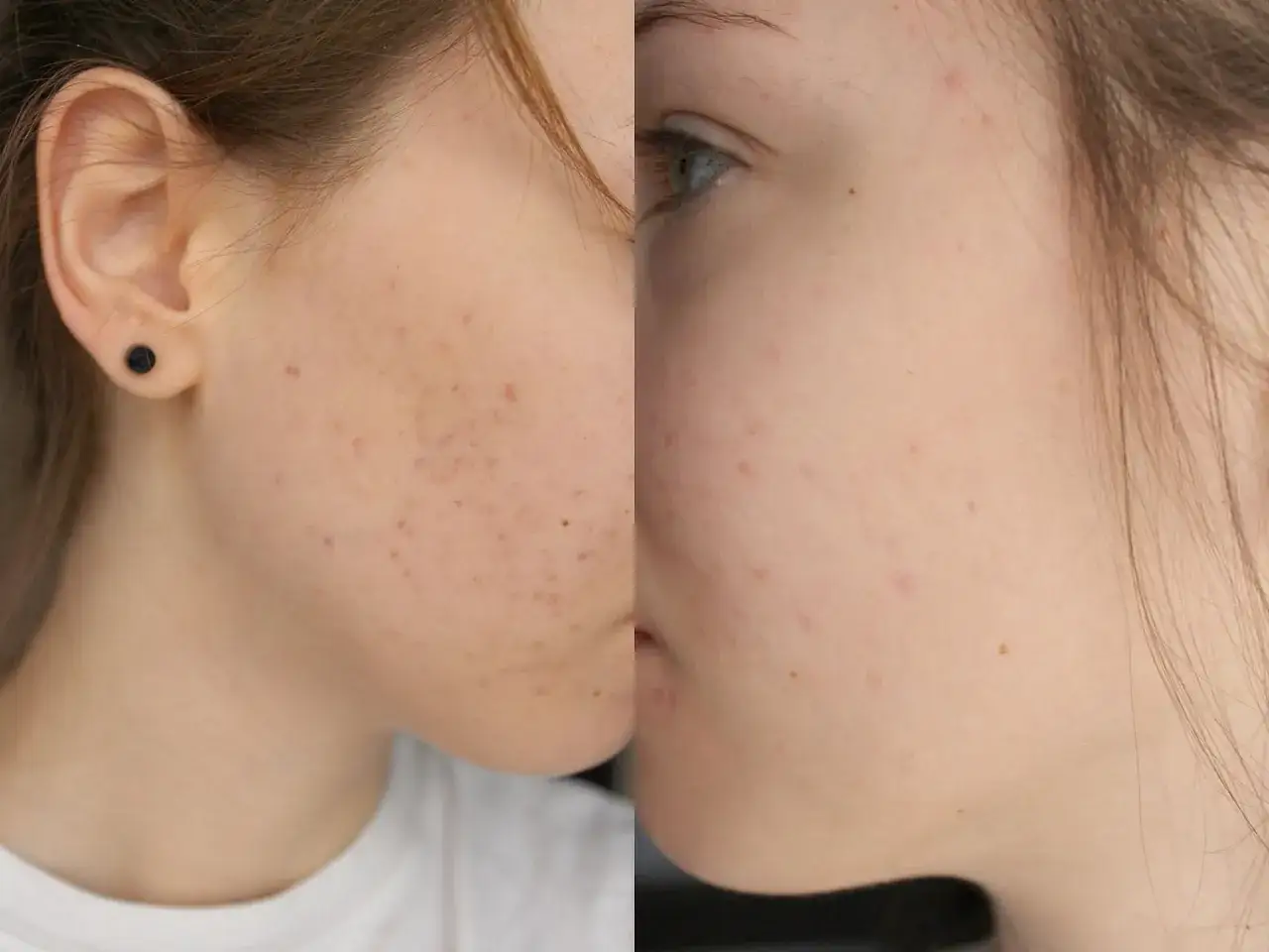 La Roche-Posay Effaclar Duo+M efekty przed i po