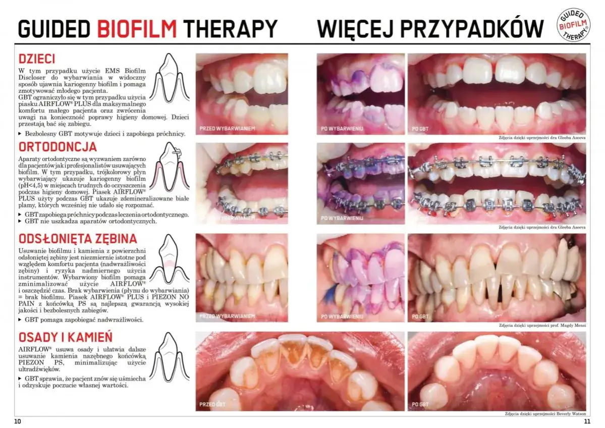 Kamień na zębach powstaje z biofilmu. Zdjęcia pokazują, jak GBT usuwa osady i kamień, przywracając piękny uśmiech.