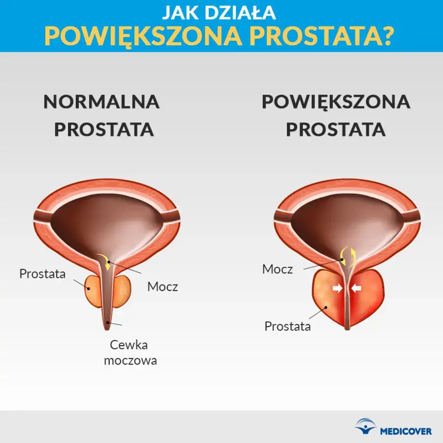 Zdjęcie Czy rak prostaty jest dziedziczny? Poznaj ryzyko w rodzinie