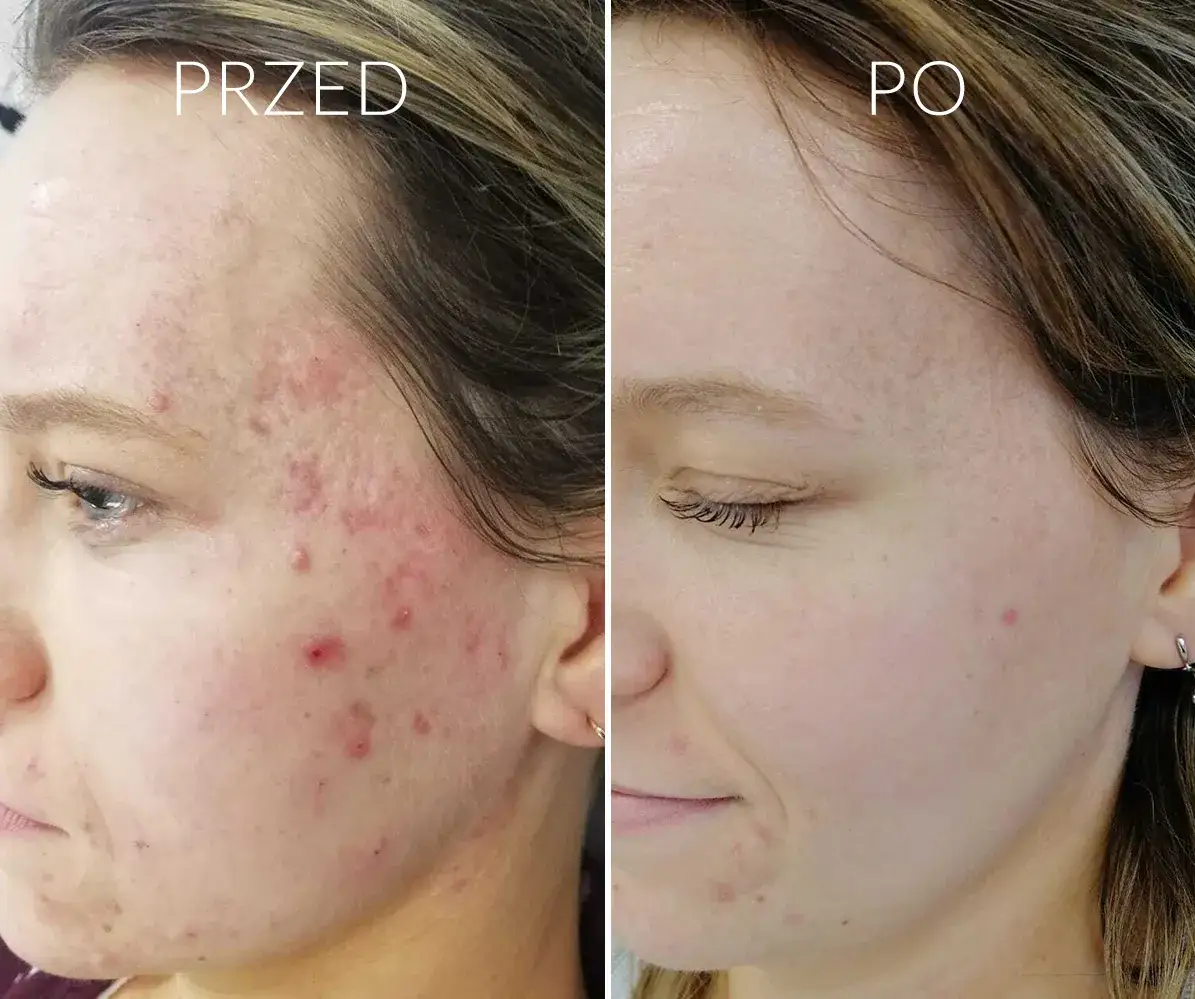 Zdjęcie Czy lód pomaga na pryszcze? Poznaj skuteczne metody łagodzenia trądziku