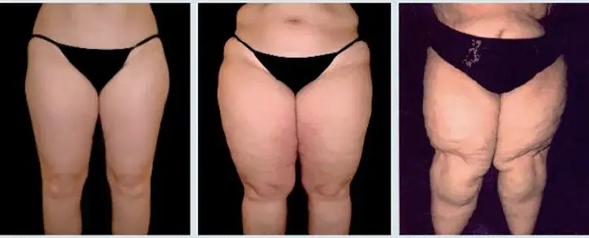 kobieta z obrzękiem n&oacute;g i cellulitem