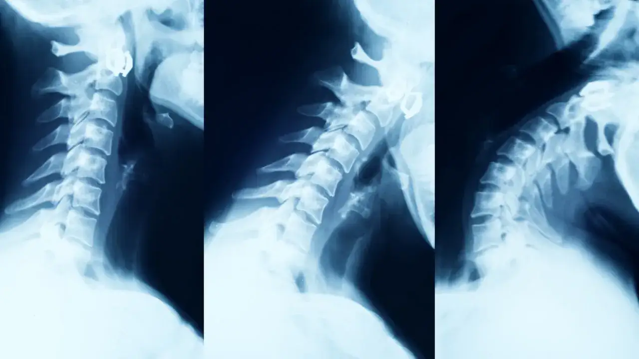 Neurologiczne objawy zwyrodnienia kręgosłupa