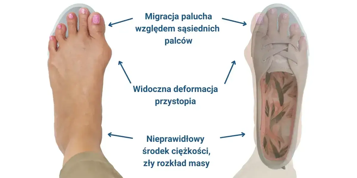 buty na haluksy cechy, budowa buta na haluksy