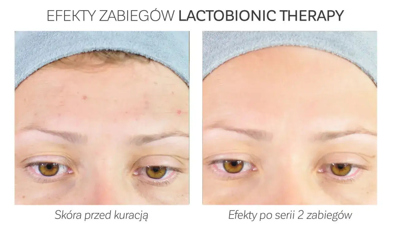 efekty stosowania kwasu laktobionowego