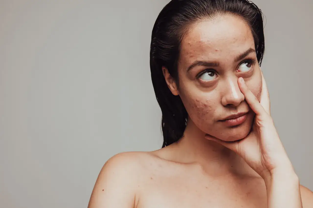 Makijaż korygujący pryszcze