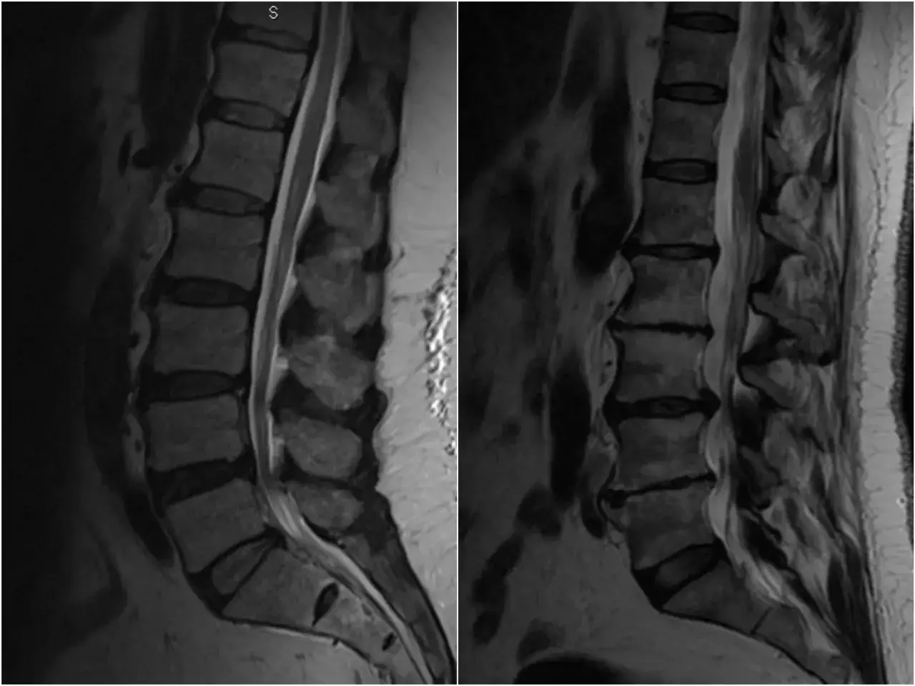 Rezonans magnetyczny kręgosłupa lędźwiowego, widoczne zmiany mogące powodować mrowienie w stopach od kręgosłupa.