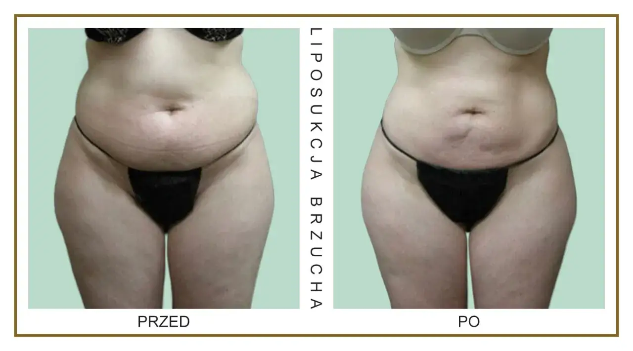 por&oacute;wnanie metod liposukcji brzucha grafika