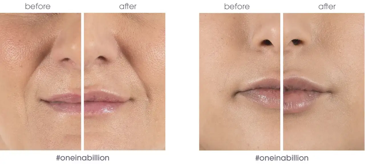 nawilżanie ust kosmetyki zabieg medycyna estetyczna