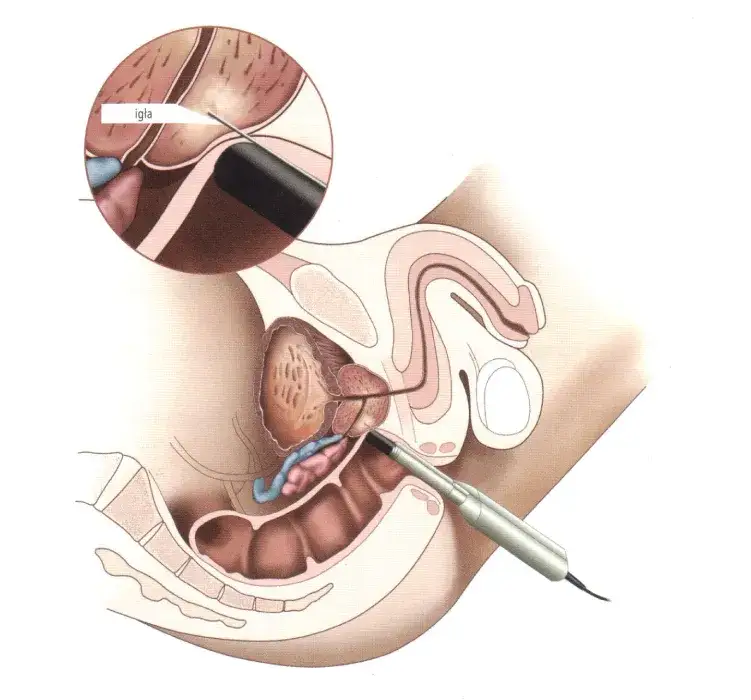przygotowanie do badania TRUS