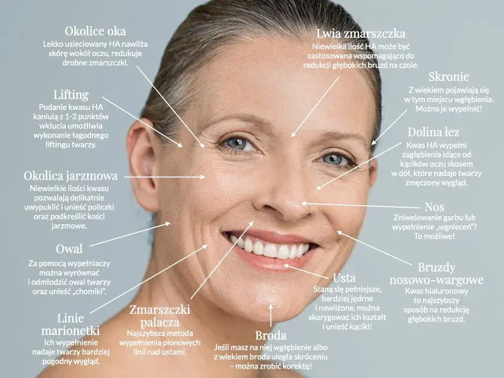 botox kwas hialuronowy obszary zastosowania twarz