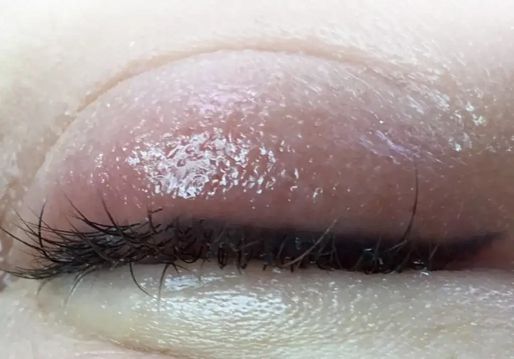 uczulenie na klej do rzęs objawy