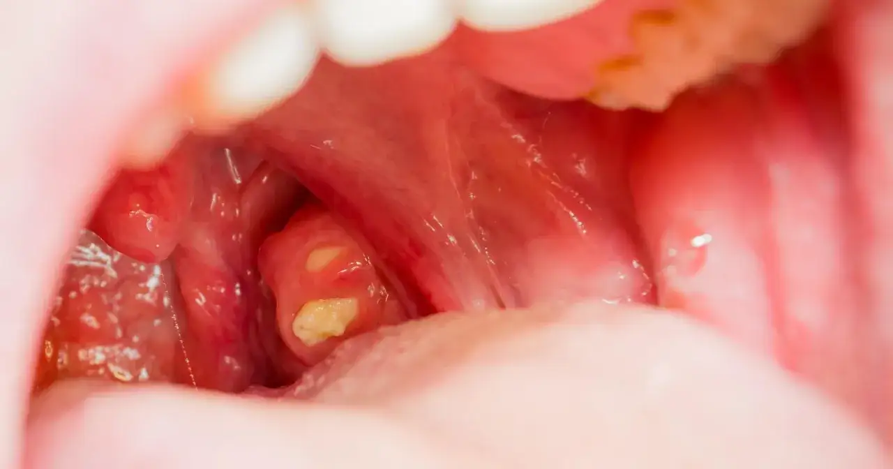 Widok migdałka z widocznymi białymi nalotami. Czy kamienie migdałkowe są groźne? Zwykle nie, ale mogą powodować dyskomfort.