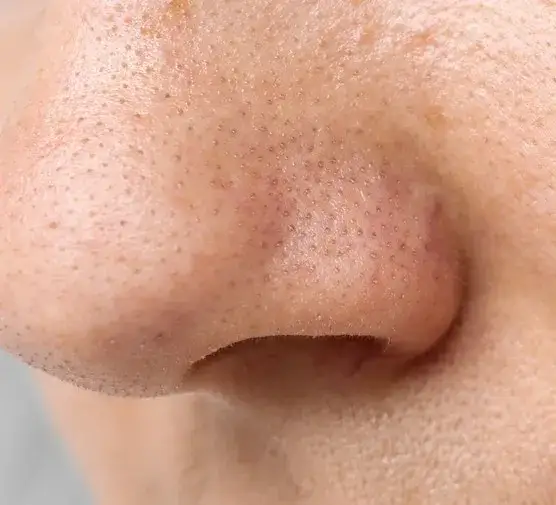 Zdjęcie Pryszcze na nosie od czego? Odkryj przyczyny i skuteczne metody leczenia