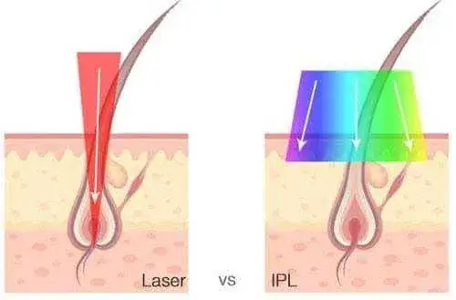 depilacja IPL a laser gabinetowy porównanie