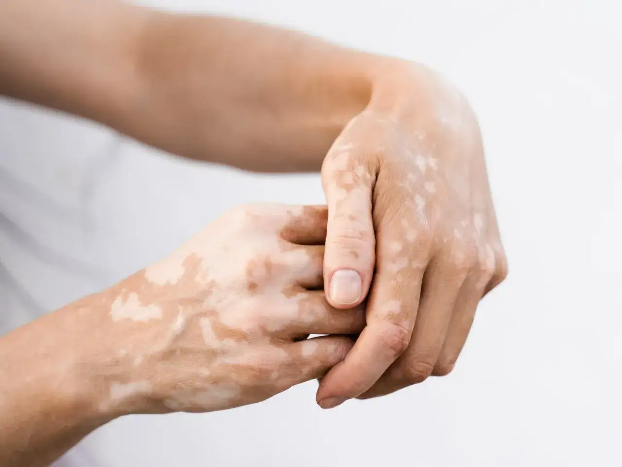 Dłonie z widocznymi białymi kropkami na skórze, tworzącymi unikalny wzór.