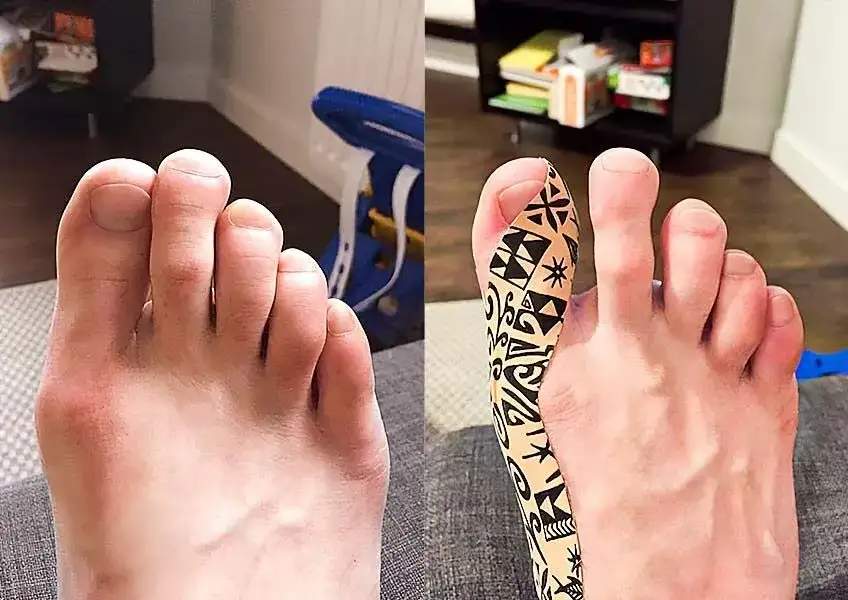Plaster na haluksy na stopie