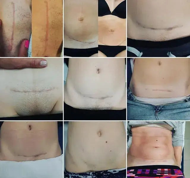 blizna po cesarskim cięciu mobilizacja