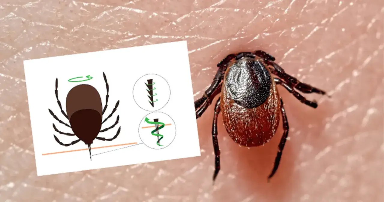 Mały kleszcz w skórze, z ilustracją pokazującą jego budowę i sposób usuwania.