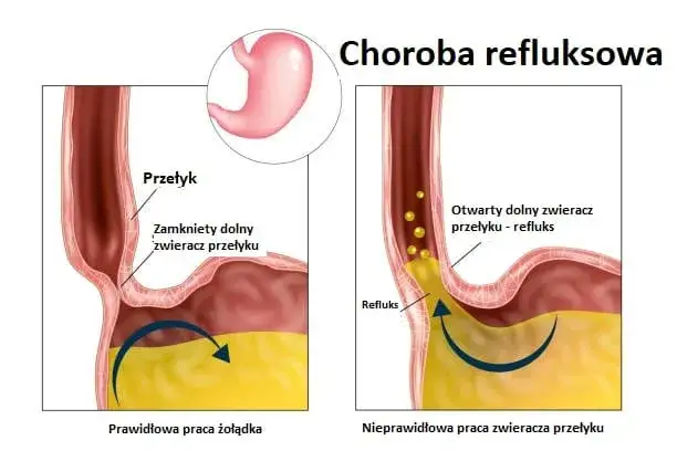 refluks krtaniowo-gardłowy mechanizm