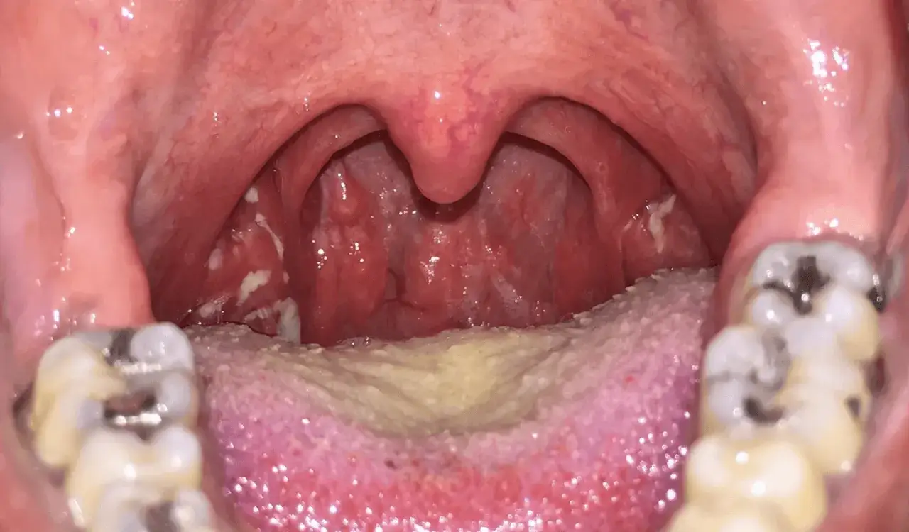 Widok jamy ustnej z widocznym ropnym zapaleniem gardła, obrzękiem migdałków i nalotem na języku.