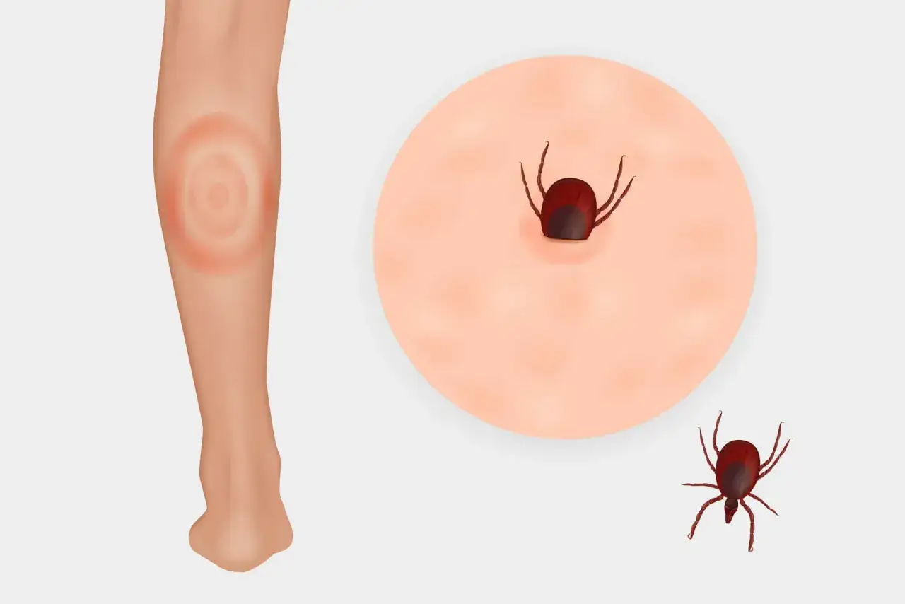kleszcz na skórze, rumień wędrujący