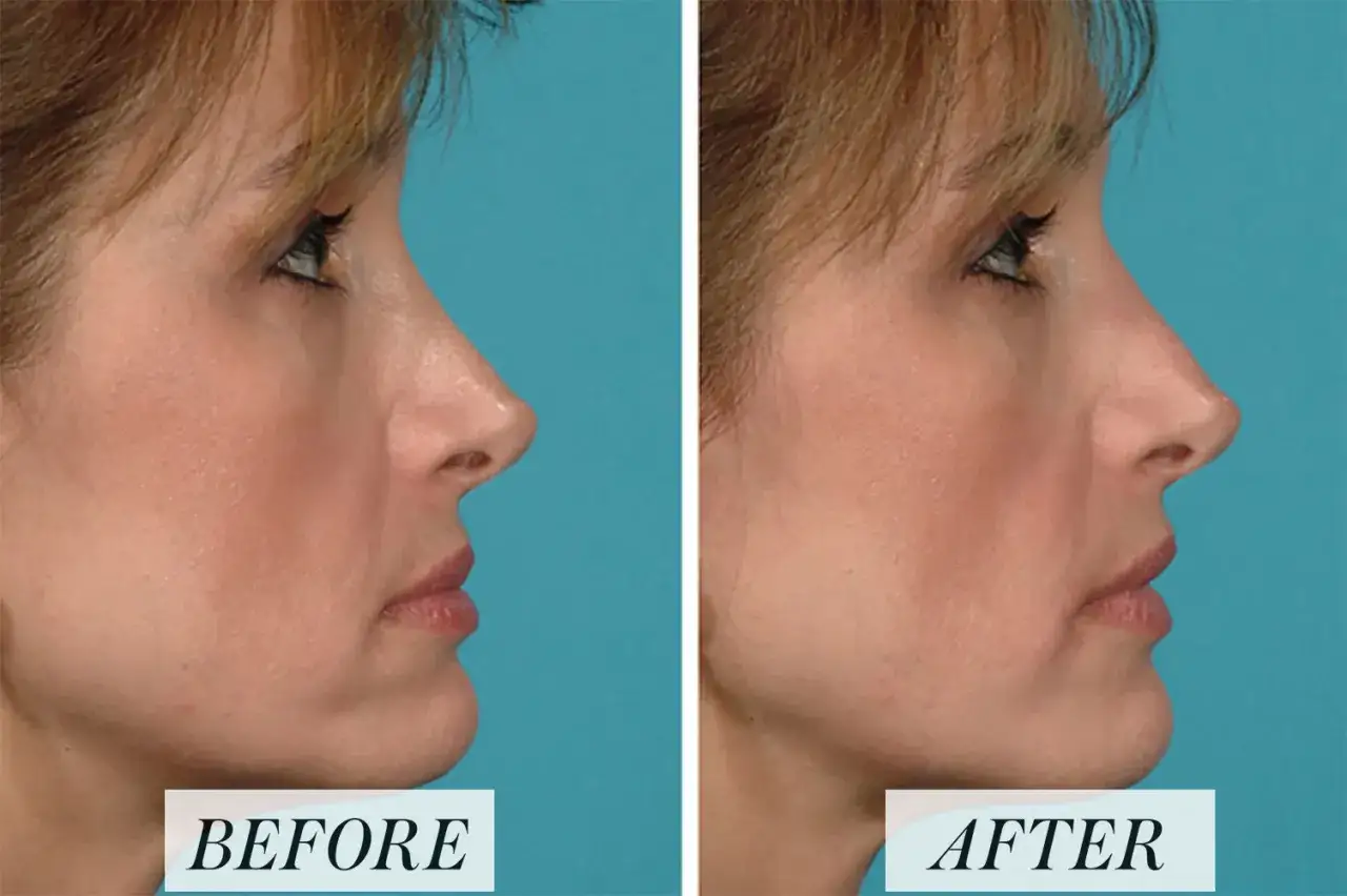 Przed i po zabiegu z użyciem kwasu hialuronowego na nos. Widoczna subtelna zmiana profilu.