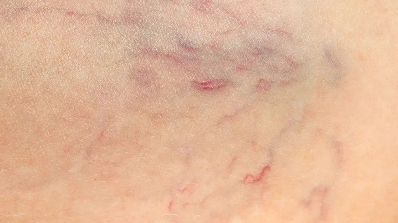 Widoczne pajęczynki naczyń krwionośnych na sk&oacute;rze. Dowiedz się, jak wzmocnić naczynia krwionośne, by poprawić ich wygląd.