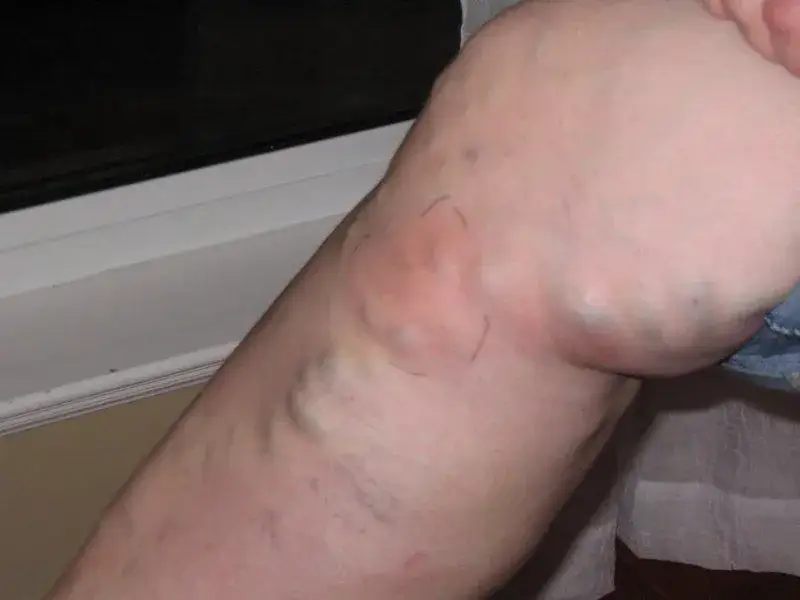 zakrzepica żył głębokich objawy noga