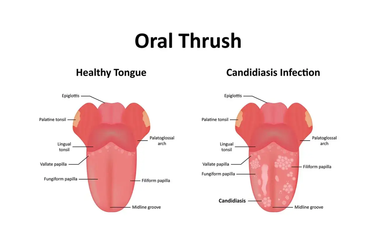 Porównanie zdrowego języka z językiem zakażonym pleśniawkami. Domowe sposoby na pleśniawki mogą pomóc w walce z tym schorzeniem.
