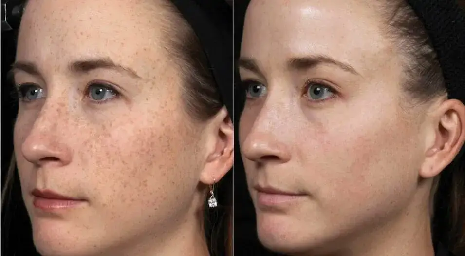 kobieta z promienną cerą, przed i po rozjaśnianiu przebarwień