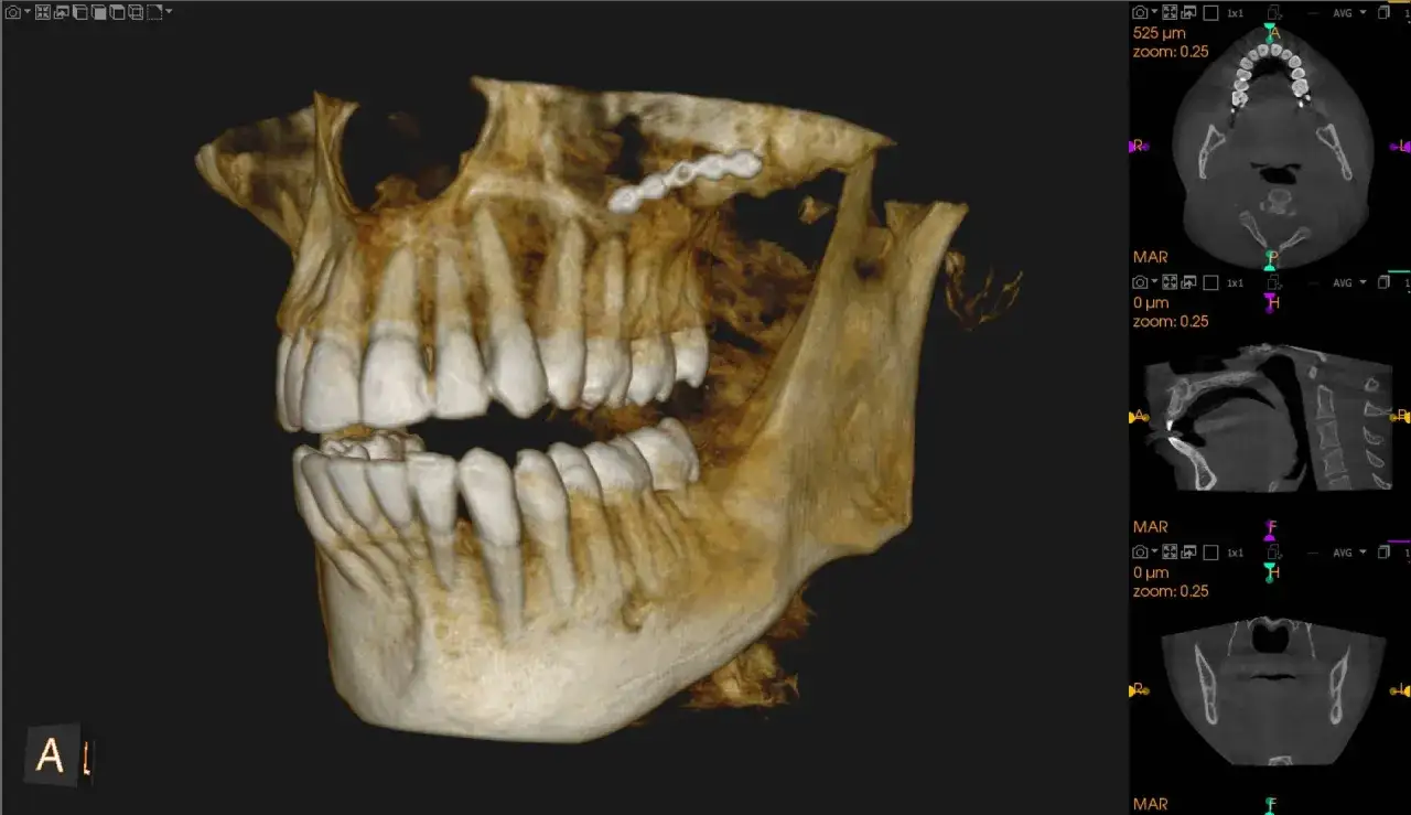 Różne rodzaje zdjęć rentgenowskich zębów (RTG punktowe, pantomogram, CBCT)