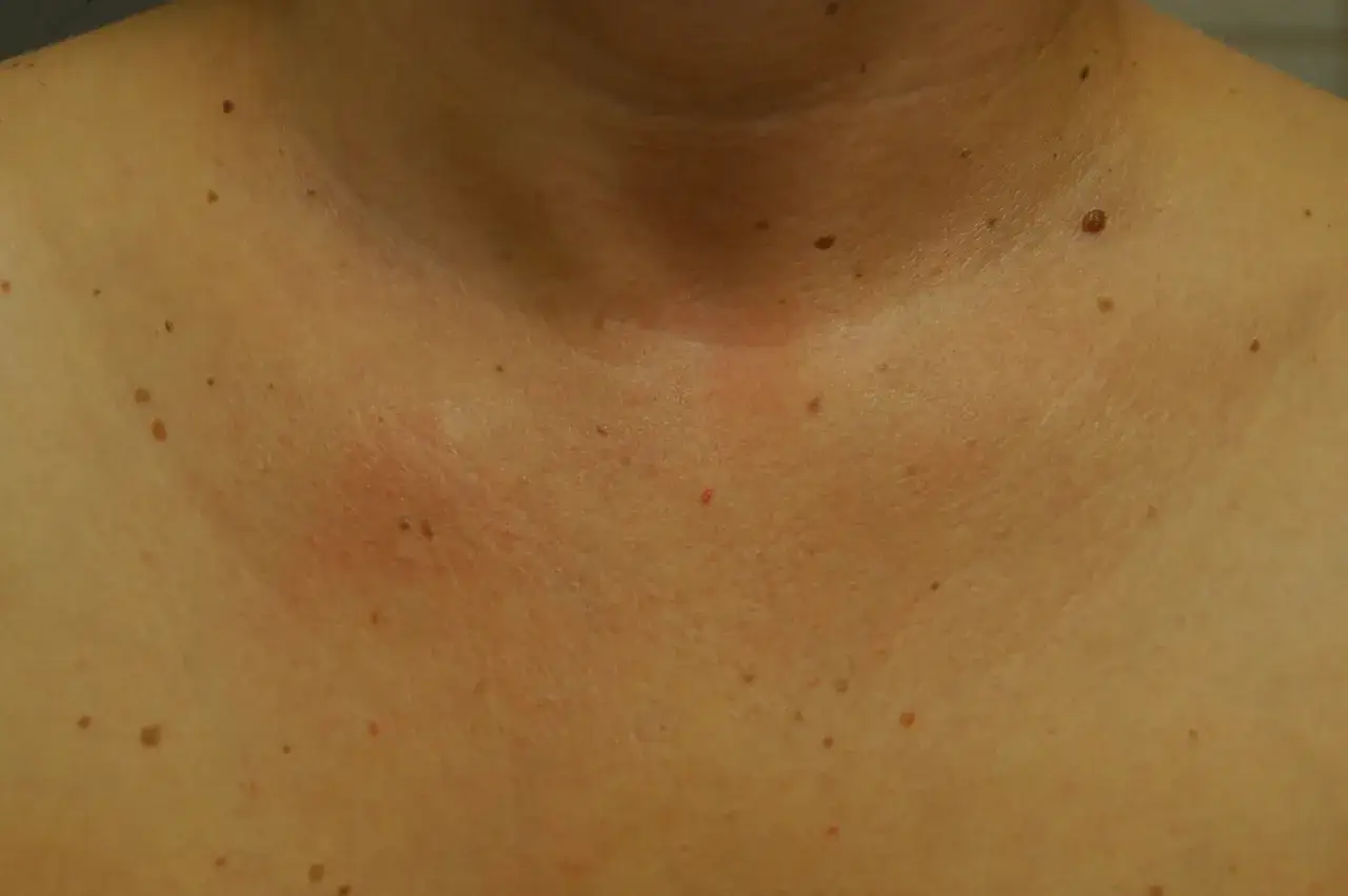 przed i po zabiegi naszyjnik wenus