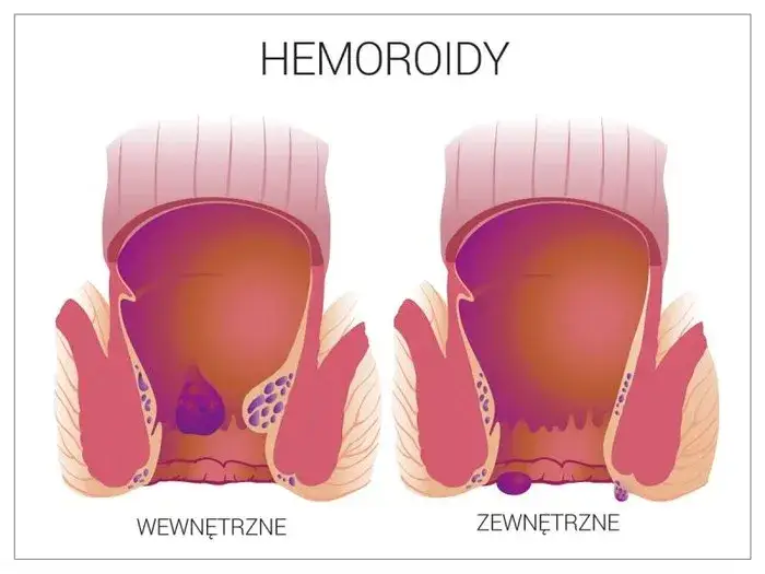 Hemoroidy w ciąży przyczyny ilustracja